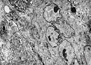 F,66y. | myositis